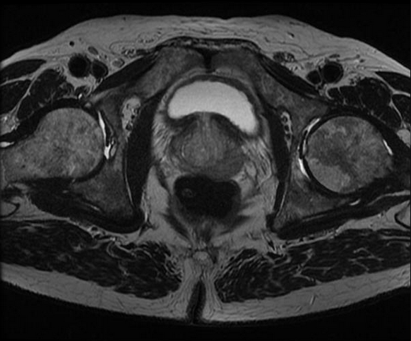 resonancia magnética Cancer próstata