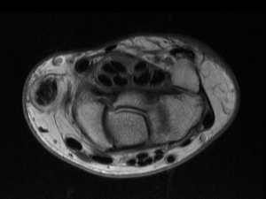 tenosinovitis quervain