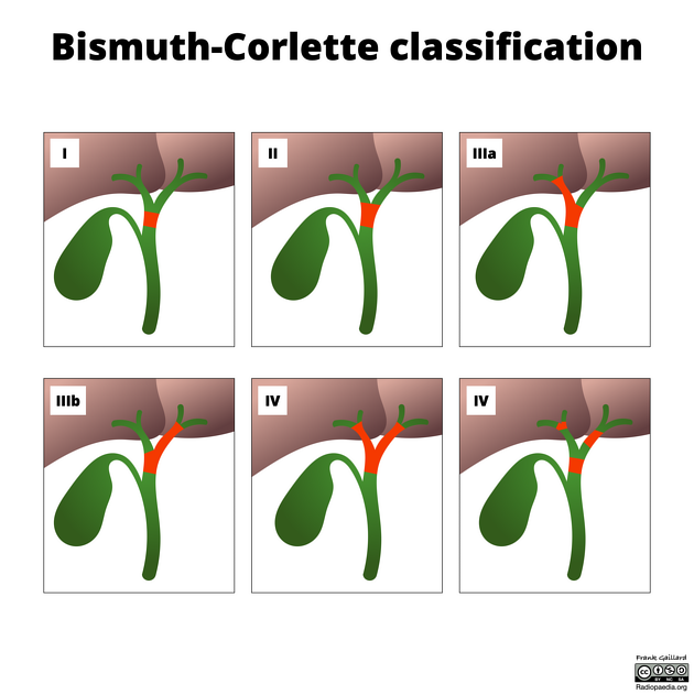 Clasificación de Bismuth-Corlette