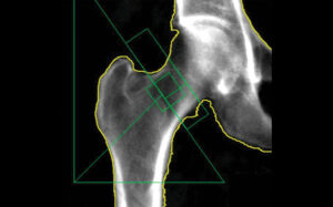 dual-energy_x-ray_absorptiometry_dxa_image_rsna_copy