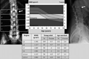 densitometria_result