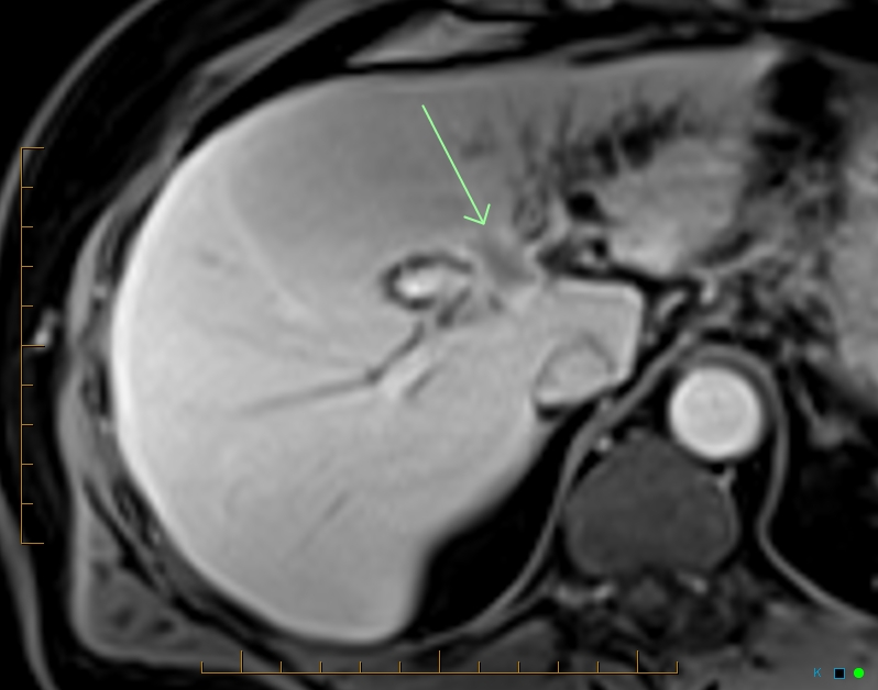 🔬 Colangiocarcinoma: Guía de Hallazgos Radiológicos, Clasificación y Manejo Clínico